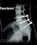 /Spinal fusion at two levels