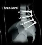 /Spinal fusion three levels   